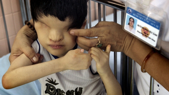 A young boy, who was born without eyes, at the Tu Du Hospital in Ho Chi Minh City, home to dozens of children who suffer from severe mental and physical disabilities as results from their parents coming in contact with Agent Orange. (Credit: Kuni Takahashi/CHI-Photo/REX/Shutterstock)