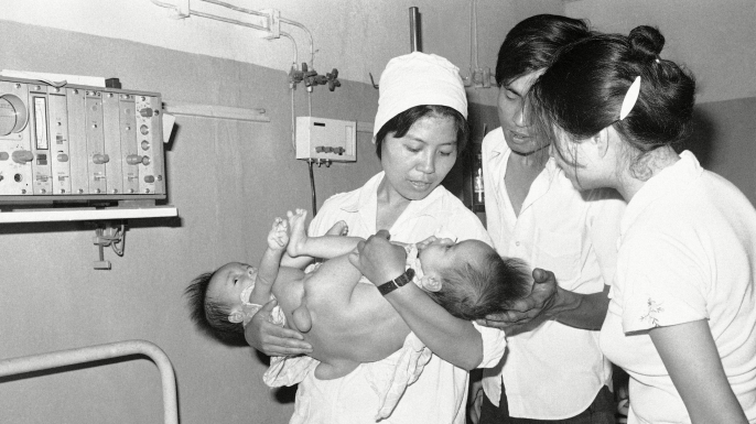 Year-old conjoined twins being cared for at Hanoi's Viet-Duc hospital, a center for treating deformed children and others who may have been affected by exposure to the defoliant Agent Orange. (Credit: Gary Mangkorn/AP/REX/Shutterstock)
