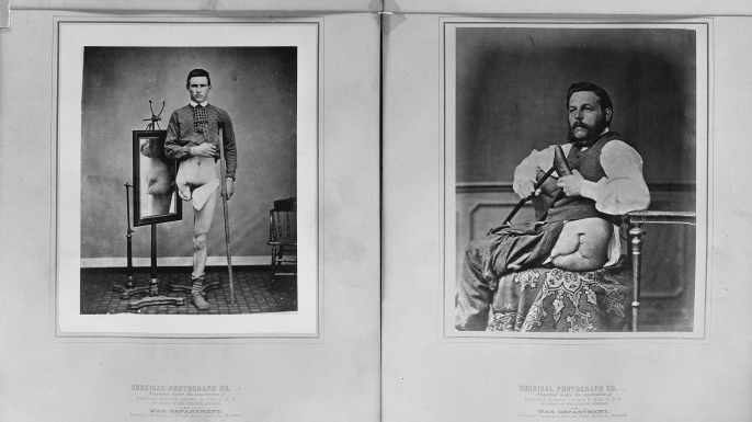 Photographs of two men displaying amputated leg wounds, circa 1860s. On the left is Eben Smith, Civil War veteran, and John Schranz, Private, 7th Austrian Feldjagers, on the right. (Credit: The Library of Congress)