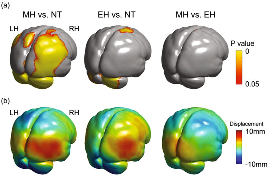 Comparisons of the brain surface morphology among Neanderthal (NT), early Homo sapiens (EH) and modern Homo sapiens (MH). The upper row shows the differences in brain surface area. The lower level shows the morphological difference in the direction perpendicular to the tangential surface. (Credit: Spring Nature/Scientific Reports)